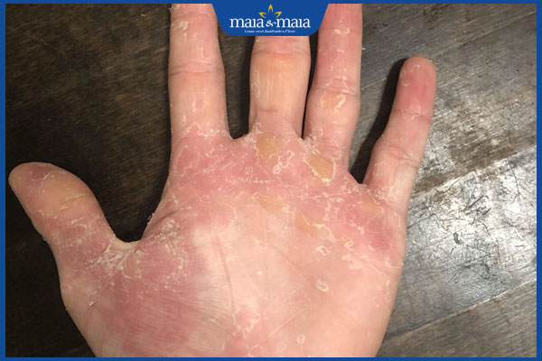 da tay khô, bong tróc