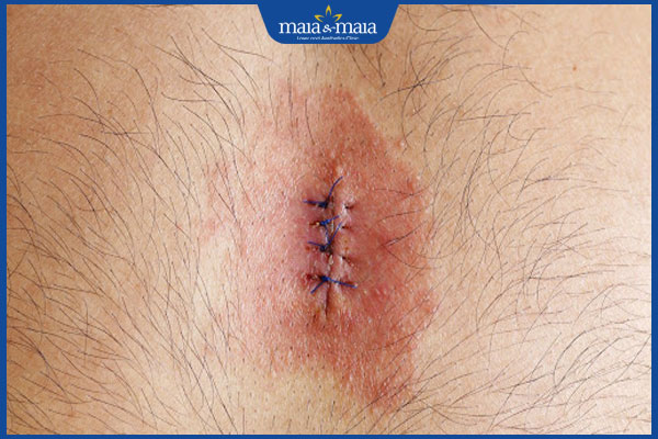 dấu hiệu dị ứng chỉ tự tiêu