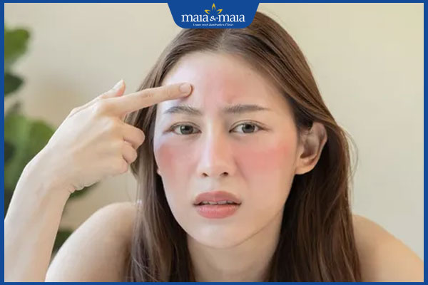 dấu hiệu dị ứng kem dưỡng ẩm