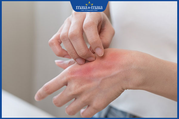 dấu hiệu dị ứng latex