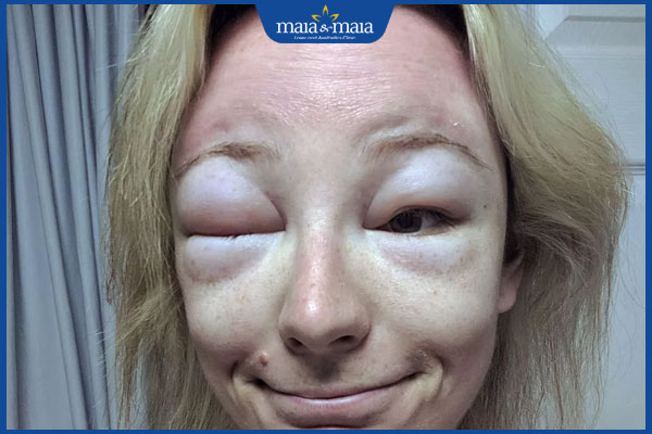 dấu hiệu dị ứng paracetamol