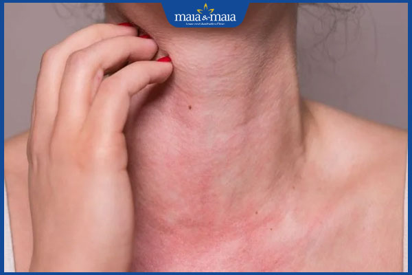 dấu hiệu dị ứng silicon