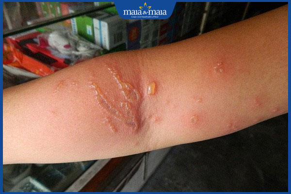 dấu hiệu dị ứng sứa biển