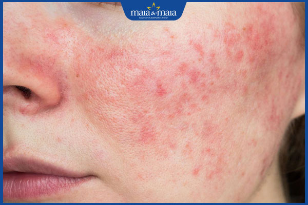 dấu hiệu dị ứng trên mặt