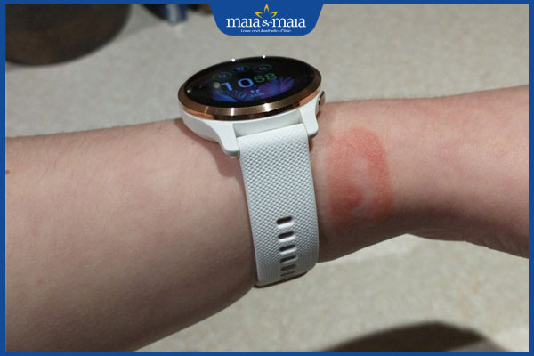 dấu hiệu dị ứng với dây da đồng hồ