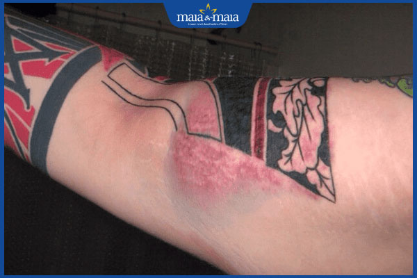 dấu hiệu dị ứng xăm