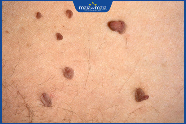 dấu hiệu u mềm treo