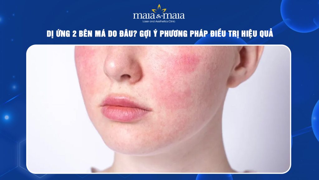 Dị ứng 2 bên má