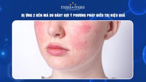 Dị ứng 2 bên má