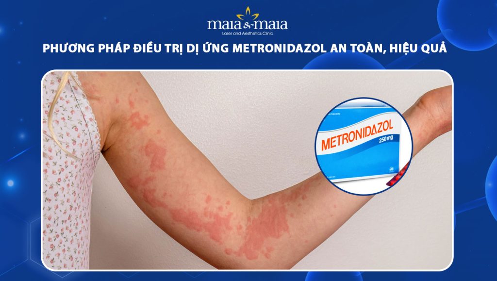 dị ứng Metronidazol