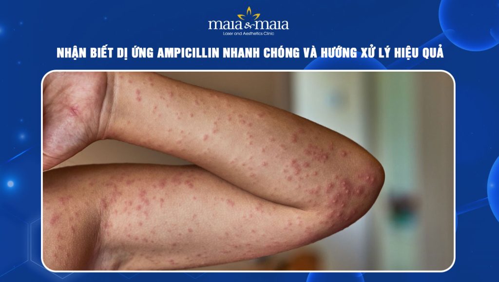 dị ứng Ampicillin