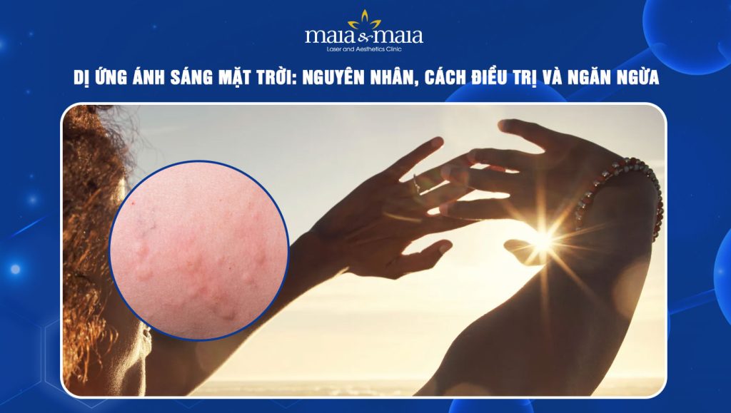 Dị ứng ánh sáng mặt trời