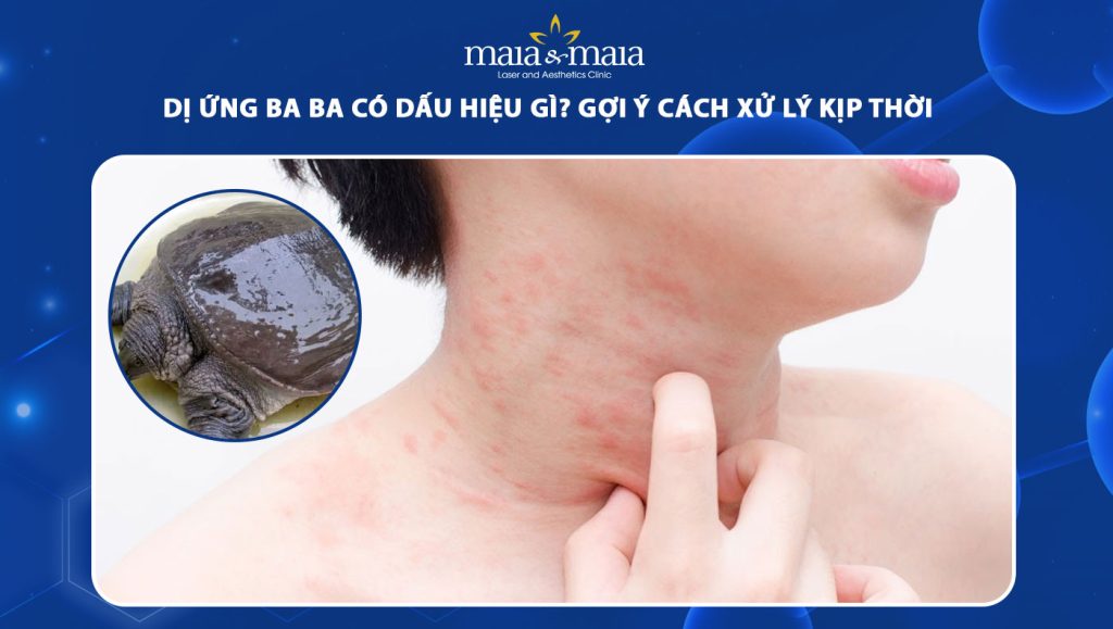 dị ứng ba ba