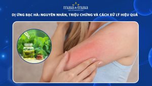 dị ứng bạc hà