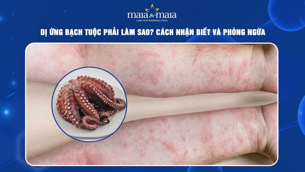 Dị ứng bạch tuộc