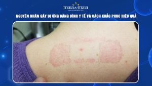 dị ứng băng dính y tế