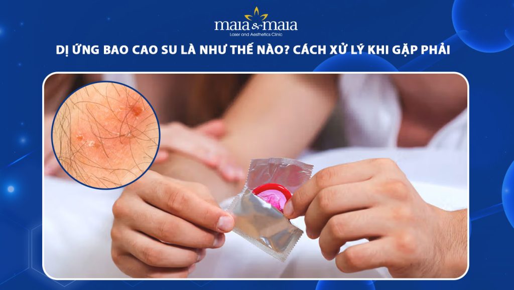 dị ứng bao cao su