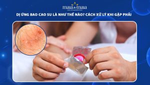 dị ứng bao cao su