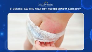 dị ứng bỉm