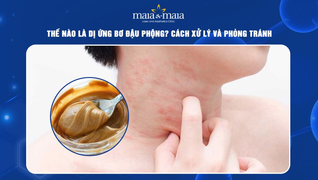 Dị ứng bơ đậu phộng