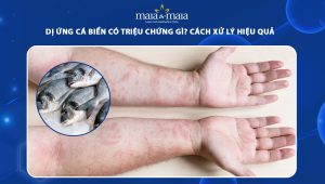 dị ứng cá biển