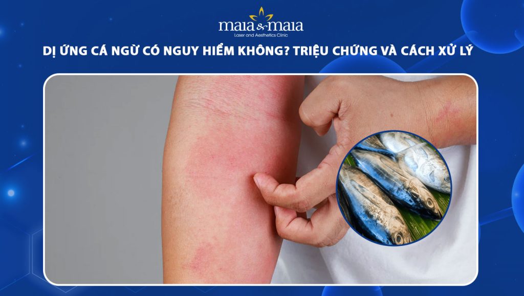 Dị ứng cá ngừ có nguy hiểm không? Triệu chứng và cách xử lý 1 dị ứng cá ngừ