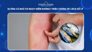 dị ứng cá ngừ