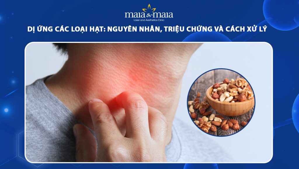 dị ứng các loại hạt