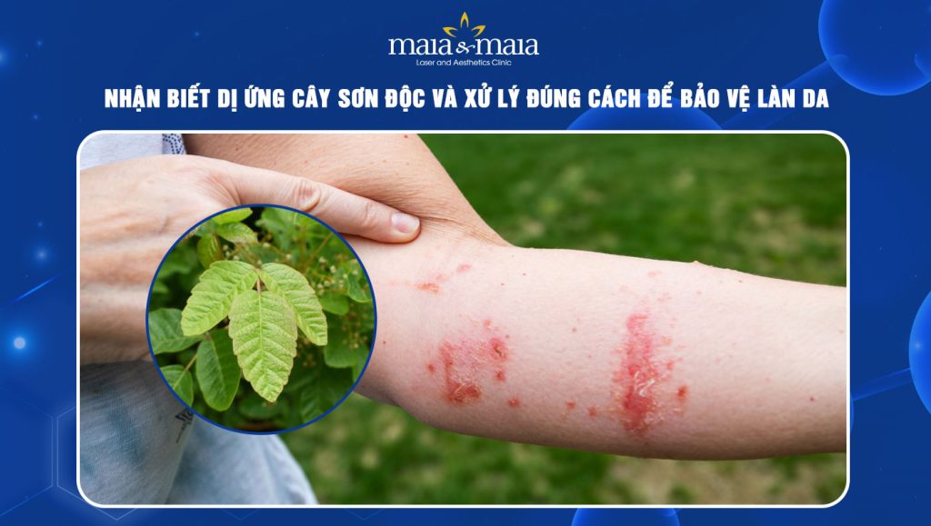 Dị ứng cây sơn độc