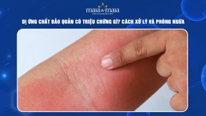 dị ứng chất bảo quản