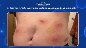 dị ứng chỉ tự tiêu