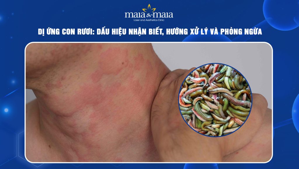 dị ứng con rươi