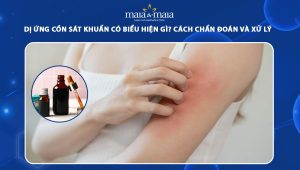 dị ứng cồn sát khuẩn