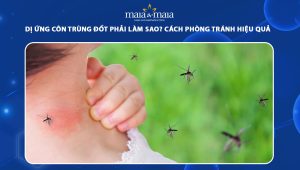 dị ứng côn trùng đốt