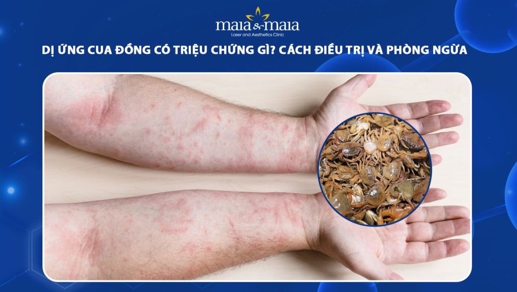 dị ứng cua đồng