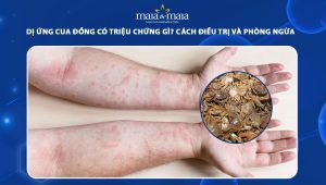 dị ứng cua đồng