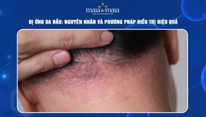 Dị ứng da đầu