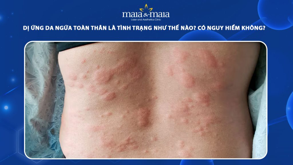 dị ứng da ngứa toàn thân