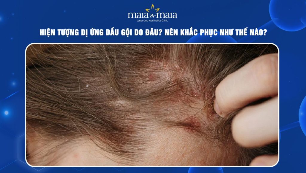 dị ứng dầu gội