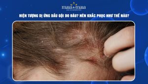 dị ứng dầu gội