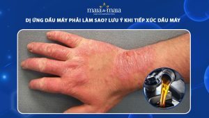 dị ứng dầu máy