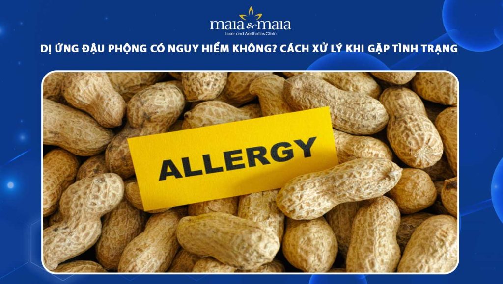 Dị ứng đậu phộng có nguy hiểm không? Làm gì khi mắc phải 1 dị ứng đậu phộng