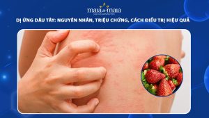 dị ứng dâu tây