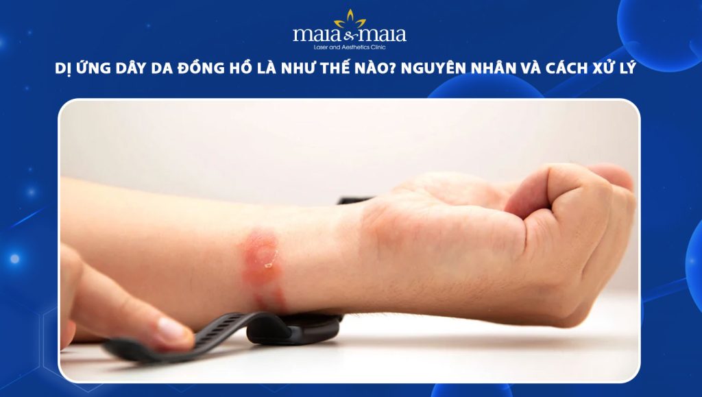 dị ứng dây da đồng hồ