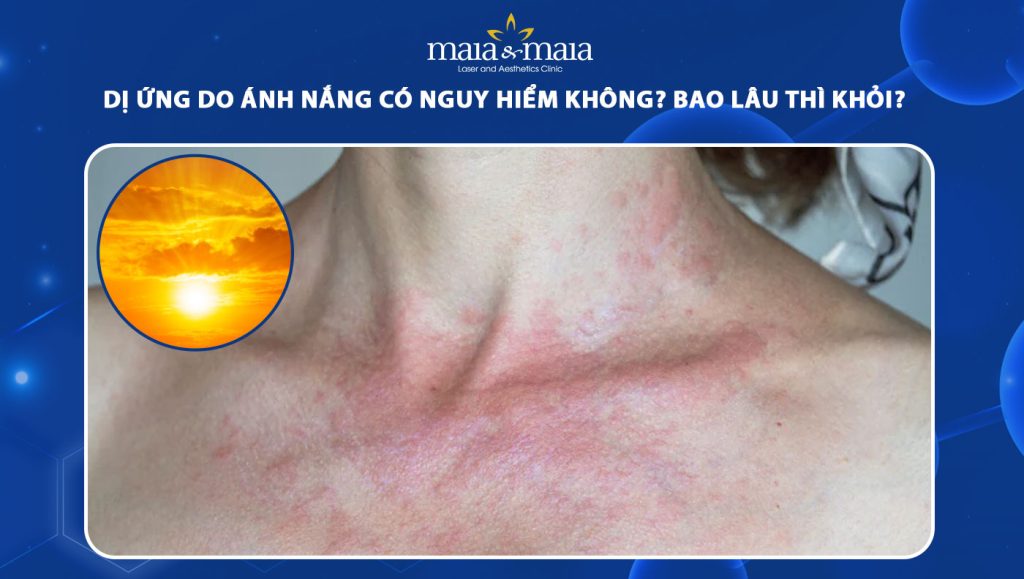 dị ứng do ánh nắng