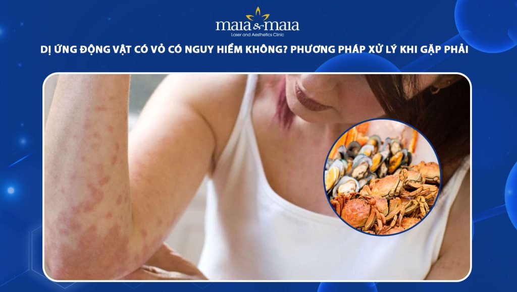 dị ứng động vật có vỏ