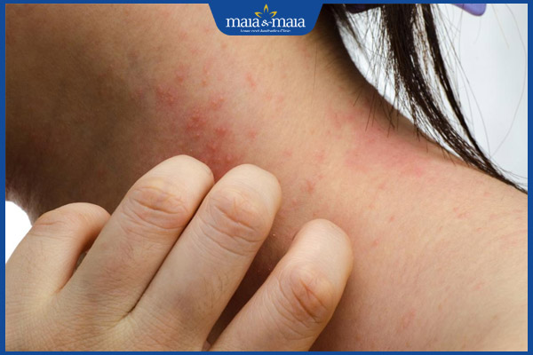 dị ứng gây ngứa cổ