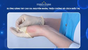 dị ứng găng tay cao su