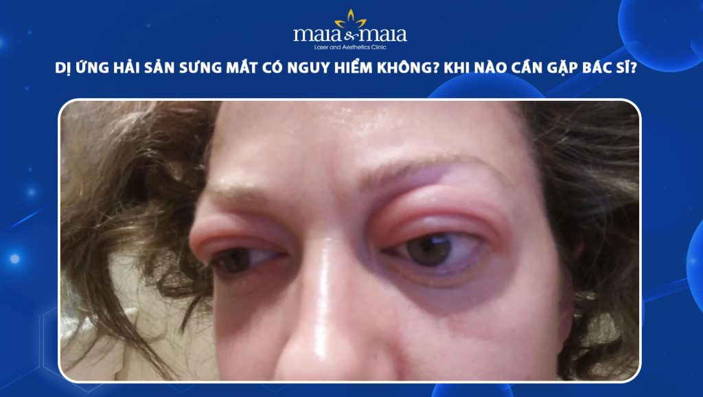 dị ứng hải sản sưng mắt