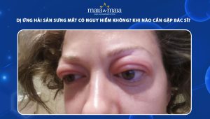 dị ứng hải sản sưng mắt